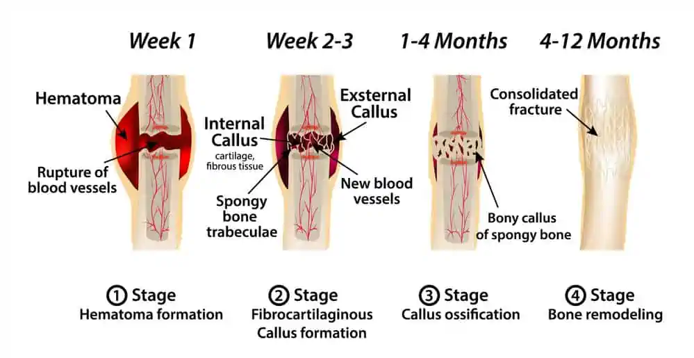 Stages of Healing a Bone Fracture